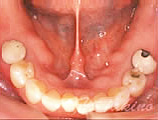 奥歯のインプラント症例のイメージ