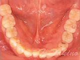 奥歯のインプラント症例のイメージ
