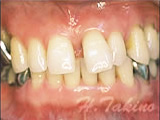 歯周病とインプラント症例のイメージ
