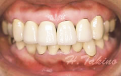 歯周病とインプラント症例のイメージ